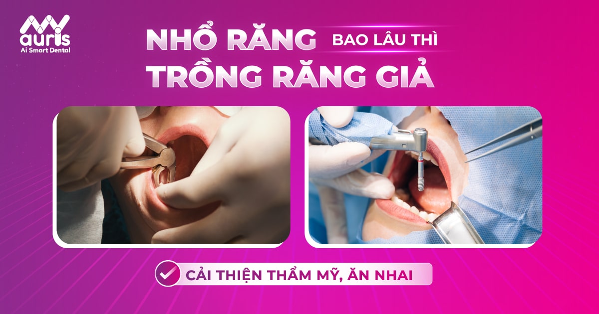 Nhổ răng bao lâu thì trồng răng giả