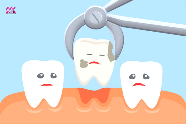 Tại sao cần trồng răng giả sau khi nhổ răng? 