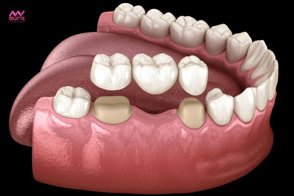 Nhổ răng sau bao lâu thì trồng răng giả cầu răng sứ? 