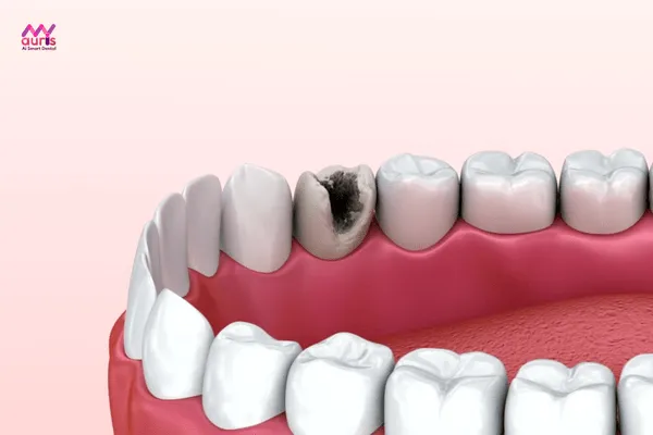 Bọc răng sứ cho răng sâu - những ai cần bọc răng sứ
