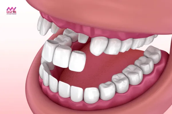 Cầu răng sứ - những phương pháp trồng răng giả 