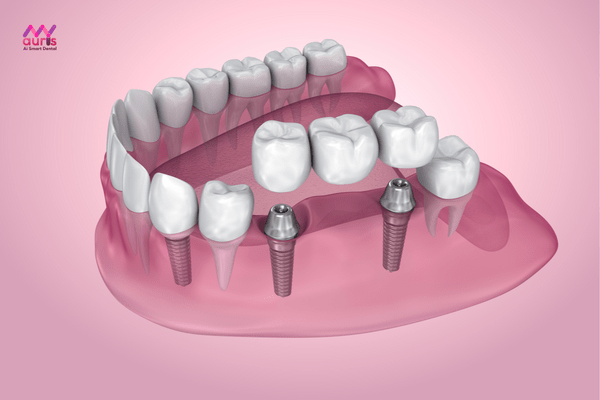 Cầu răng sứ trên implant - những phương pháp trồng răng giả 