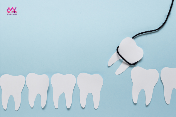Niềng răng có cần phải nhổ răng không? 