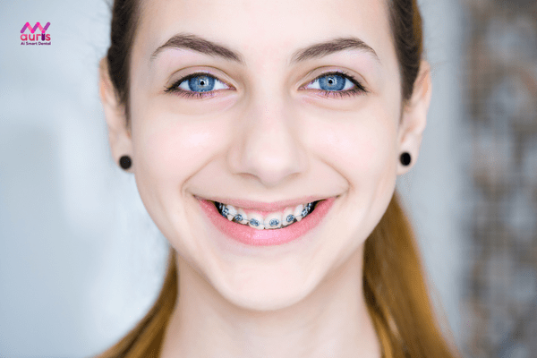 Niềng răng trong độ tuổi trưởng thành - Trường hợp nào cần nhổ răng khi niềng 