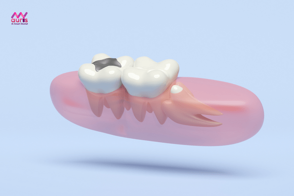 Nhổ răng khôn - Trường hợp nào cần nhổ răng khi niềng 
