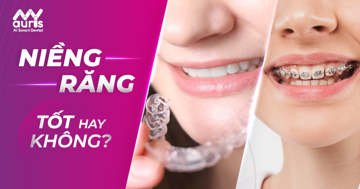 Niềng răng có tốt hay không? - 4 phương pháp thực hiện