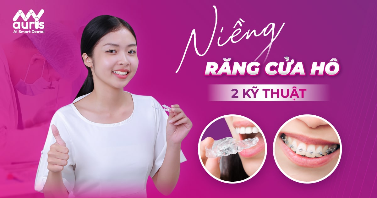 Niềng răng cửa hô - 2 kỹ thuật và thời gian thực hiện