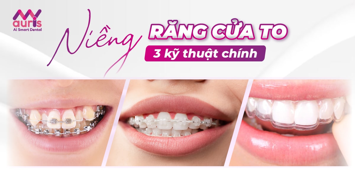 [Tìm hiểu] Niềng răng cửa to với 3 kỹ thuật chính