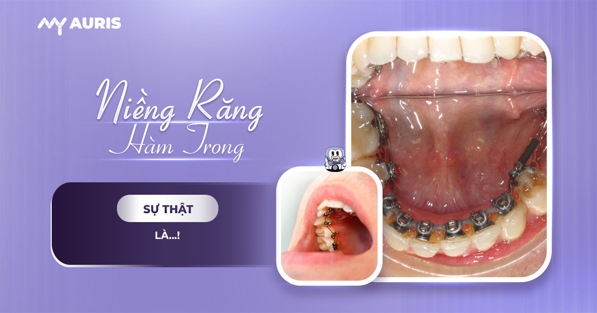 Niềng răng hàm trong