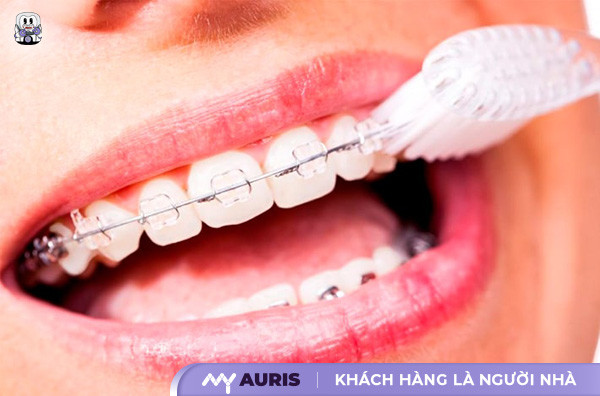 Niềng răng hàm trong