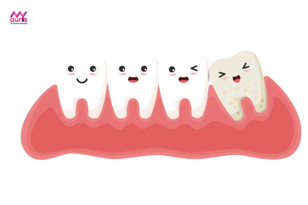 Nhổ răng khôn - Trường hợp cần nhổ răng để kết quả niềng răng như mong đợi 