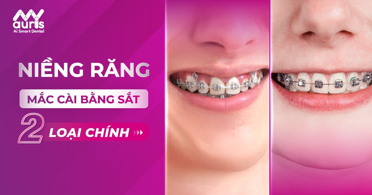 2 loại niềng răng mắc cài bằng sắt hiệu quả cần biết