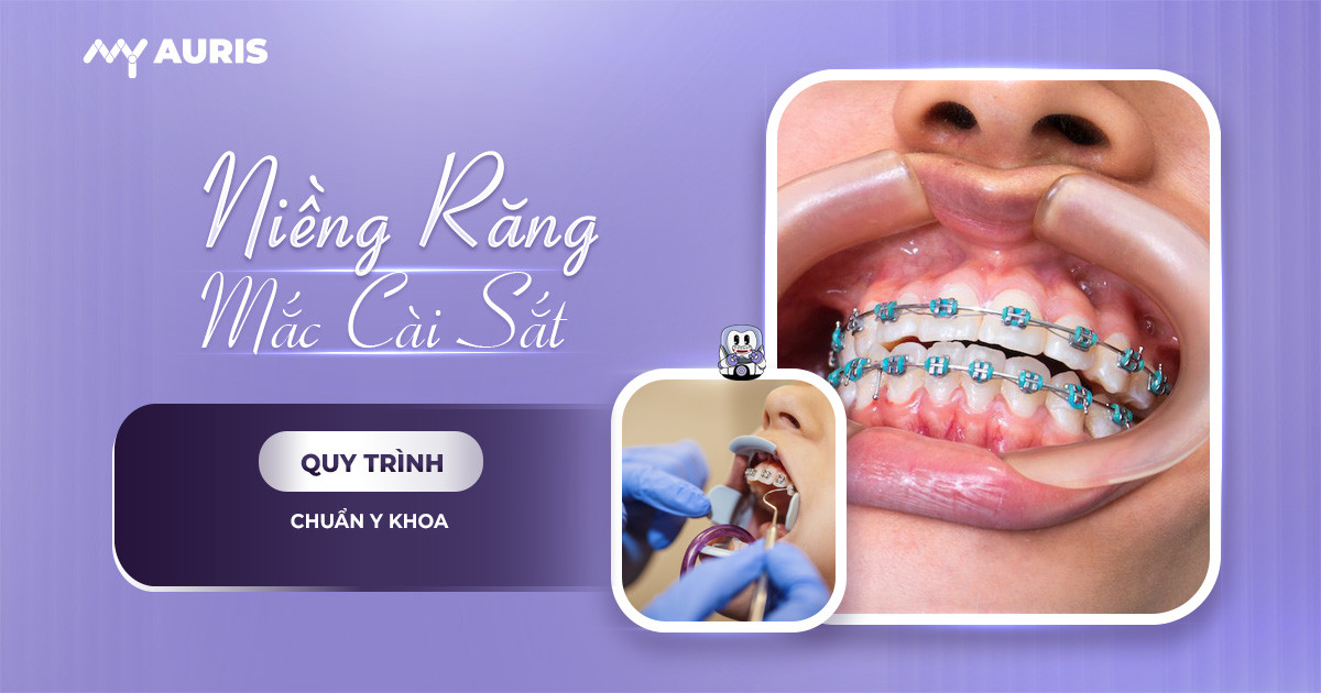 niềng răng mắc cài sắt,niềng răng mắc cài bằng sắt,niềng răng sắt,niềng sắt