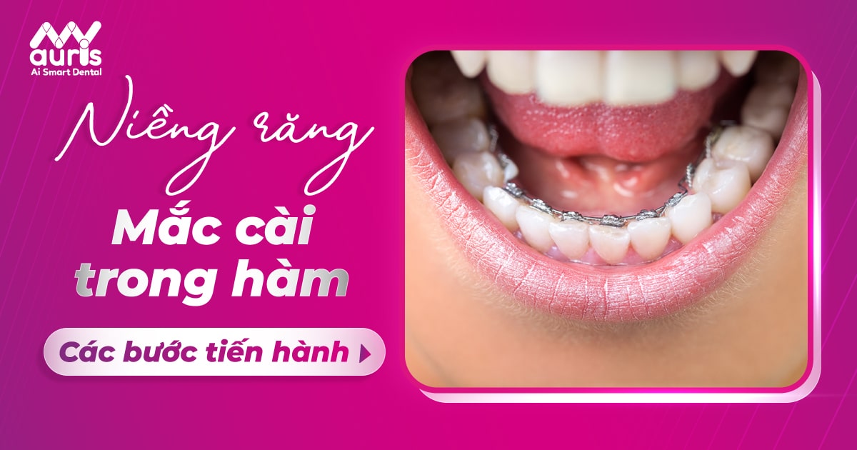 Niềng răng mắc cài trong hàm - 4 bước tiến hành chính