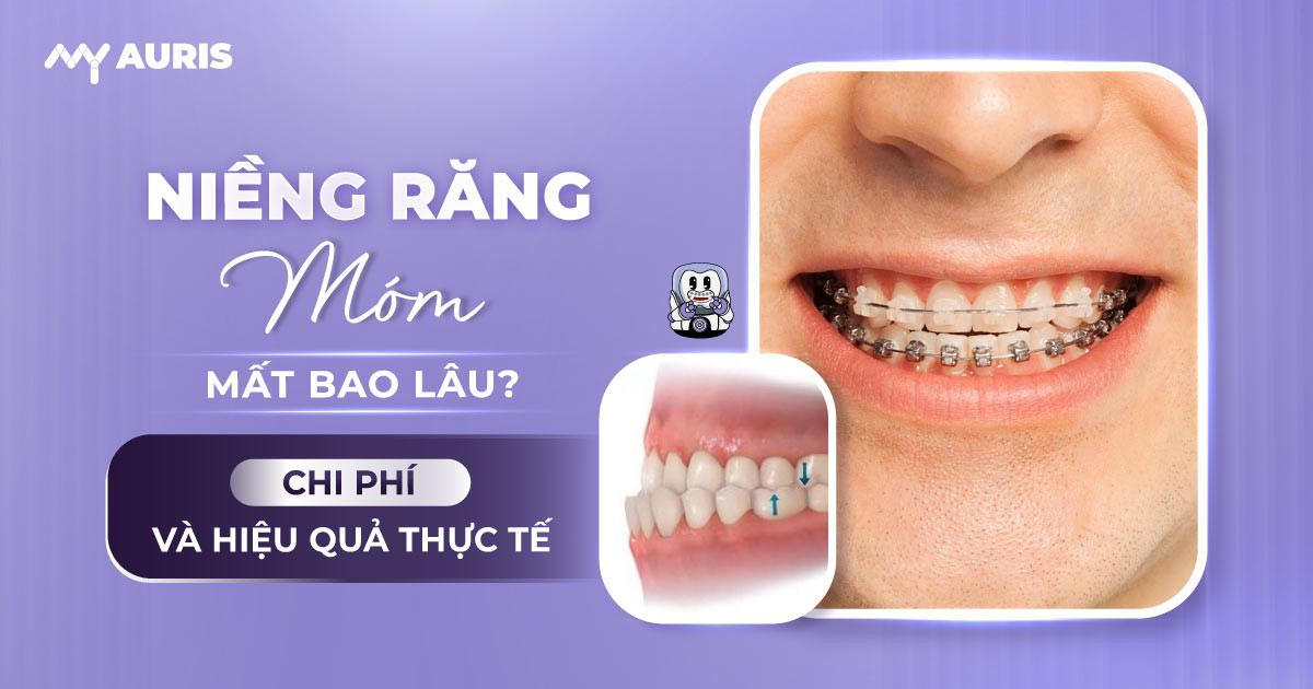 niềng răng móm mất bao lâu