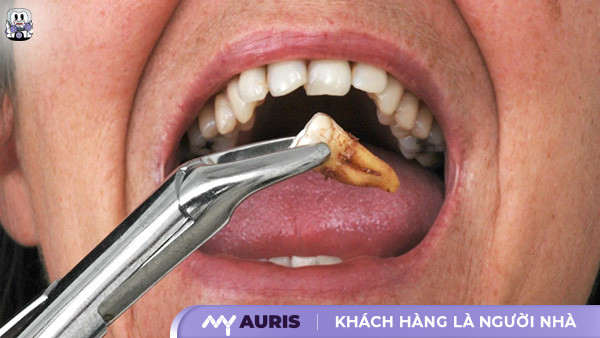niềng răng có cần phải nhổ răng khôn không,niềng răng có phải nhổ răng số 8 không