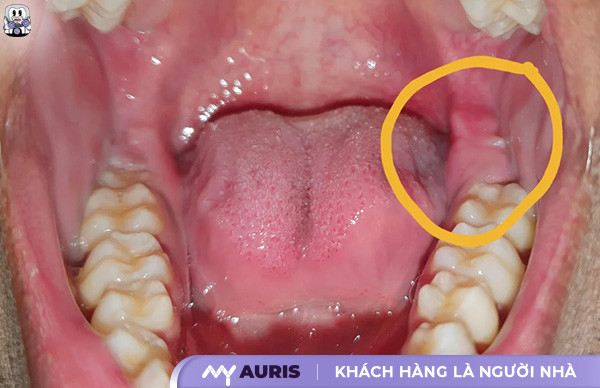 niềng răng có cần phải nhổ răng khôn không,niềng răng có phải nhổ răng số 8 không