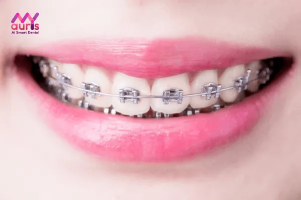 Ưu nhược điểm của niềng răng sắt là gì?