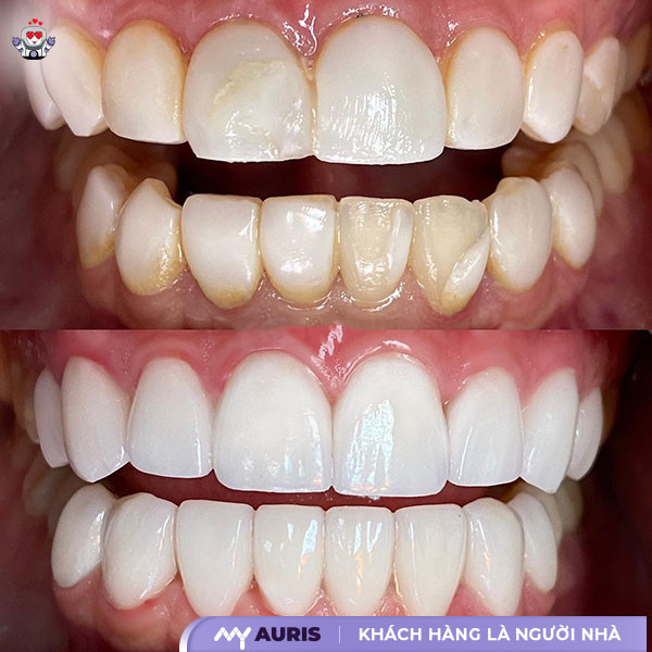 phủ sứ nano,phủ sứ nano cho răng có tốt không