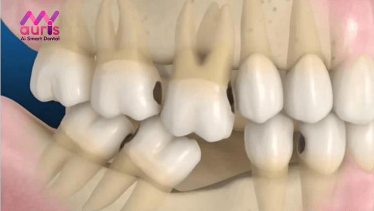 phương pháp trồng răng hàm tphcm