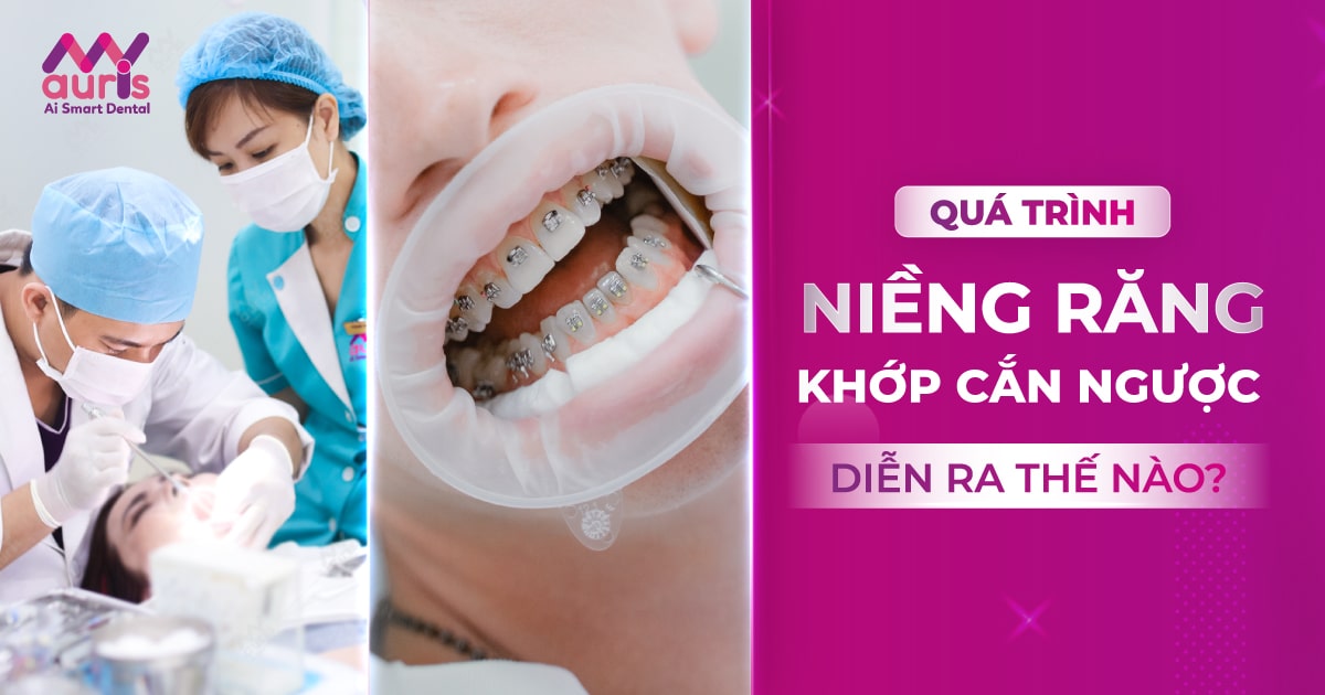 Quá trình niềng răng khớp cắn ngược diễn ra thế nào?