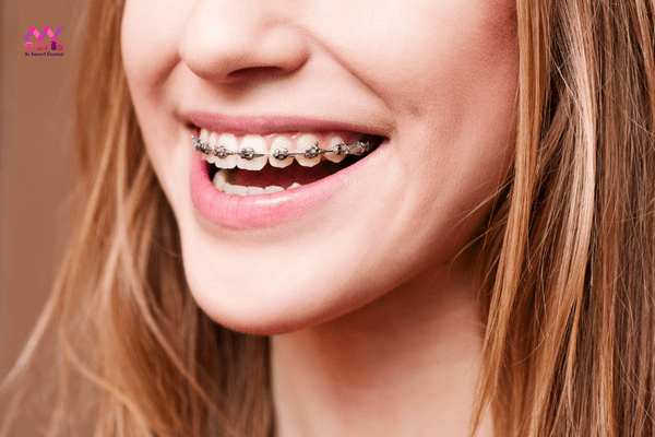 Tiến hành niềng răng - Quy trình niềng răng khớp cắn ngược