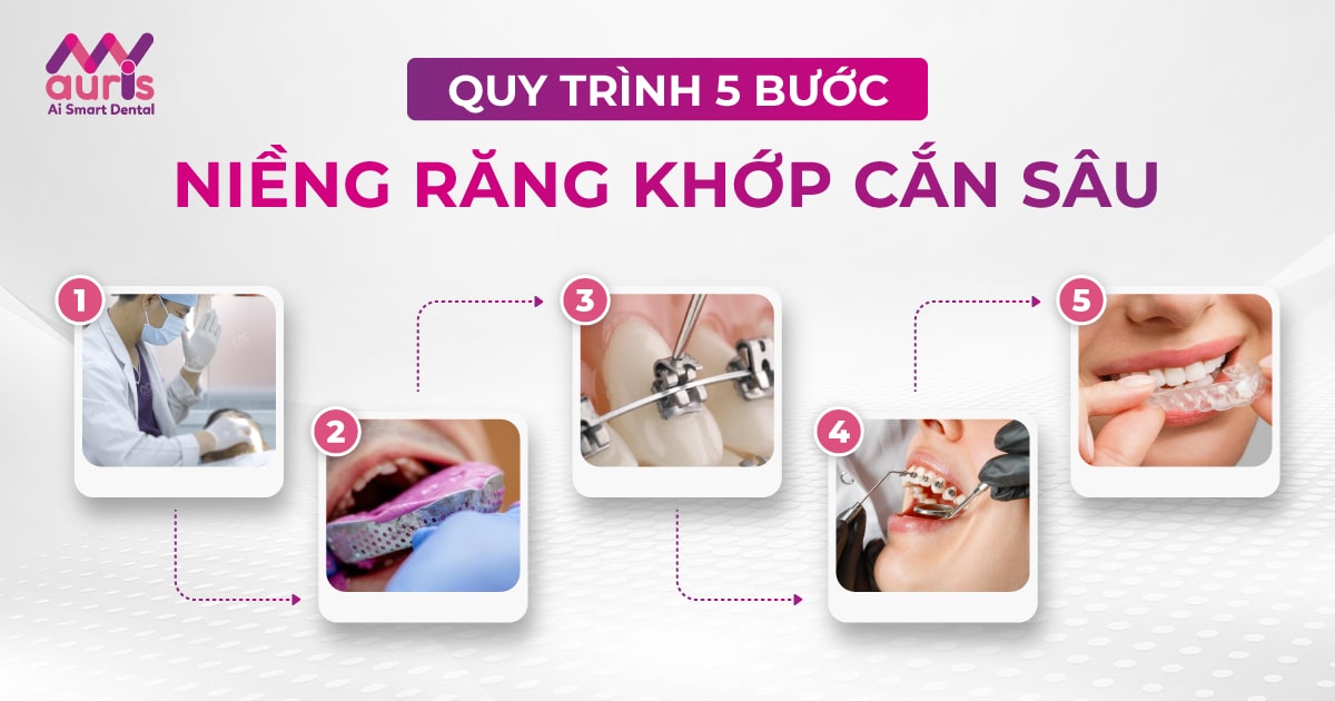 5 bước trong quy trình niềng răng khớp cắn sâu cần biết