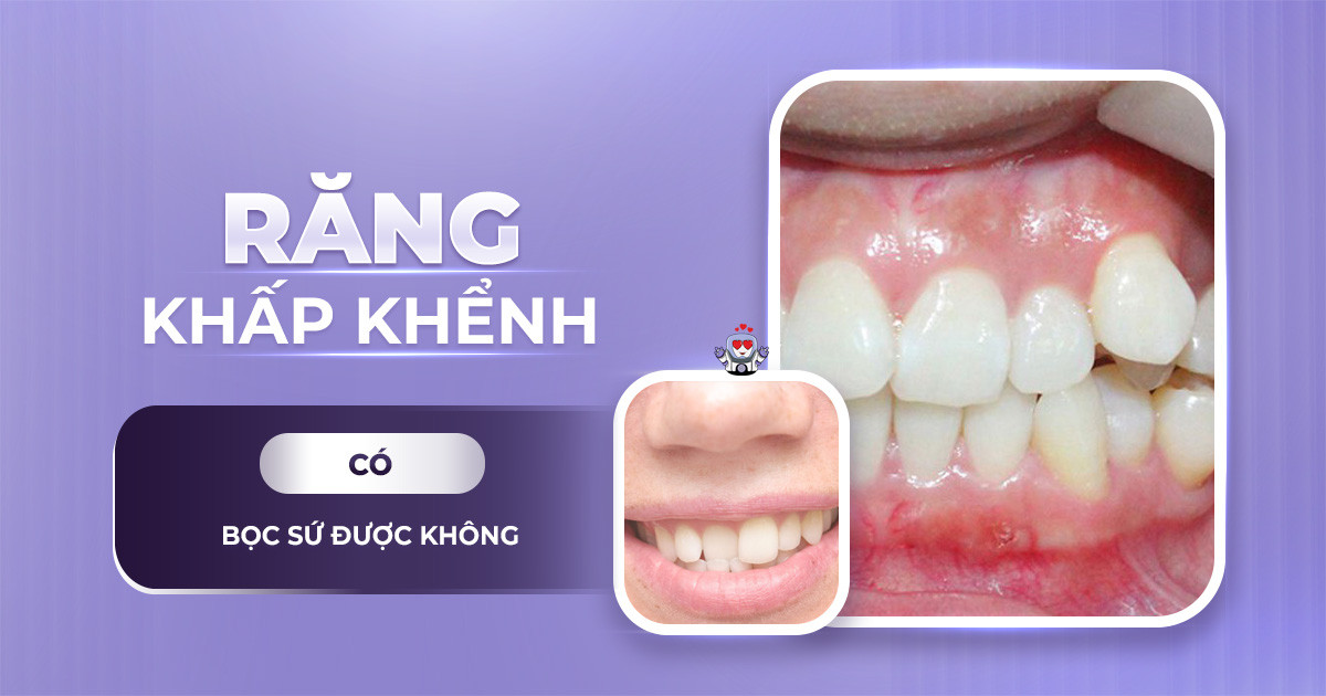 răng khấp khểnh có bọc sứ được không,răng sứ khểnh,bọc răng sứ cho răng khấp khểnh,làm răng sứ khểnh,bọc răng sứ khểnh,răng khấp khểnh có làm răng sứ được không,răng khấp khểnh nhiều có bọc sứ được không