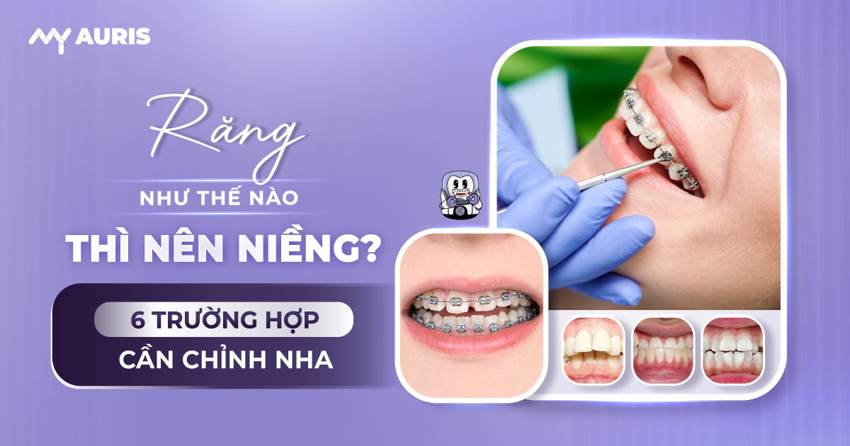 răng như thế nào thì nên niềng