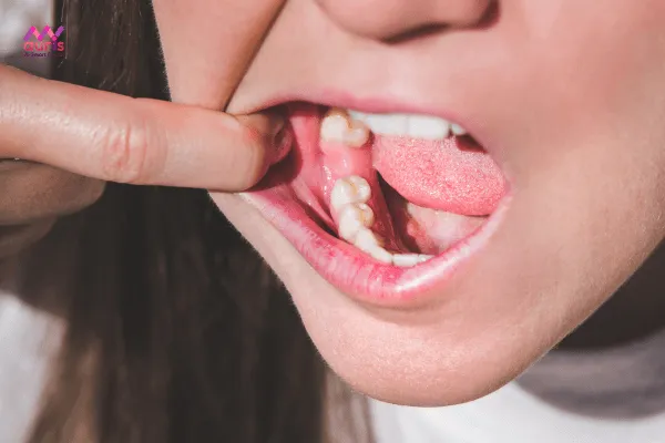 Hậu quả của nhổ răng xong không trồng răng giả 