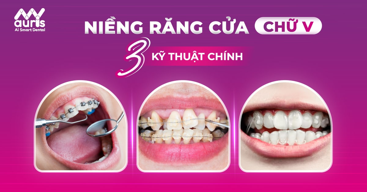 Niềng răng cửa chữ V - 3 kỹ thuật khắc phục hiệu quả