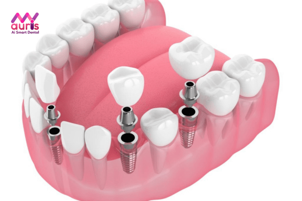 Phương pháp phục hình răng bằng Implant