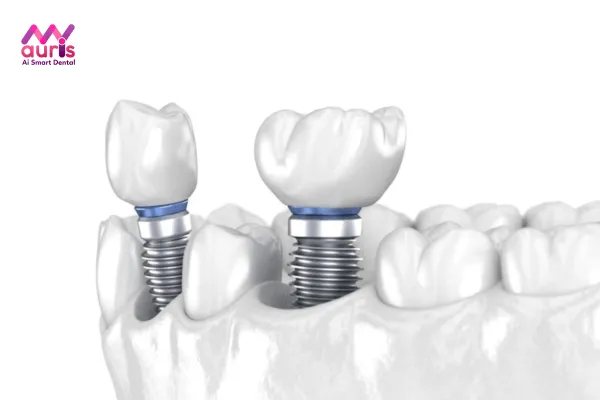 Trồng răng Implant có chi phí bao nhiêu?