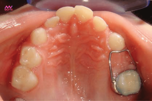 Có mấy loại hàm giữ khoảng mất răng cho trẻ? 