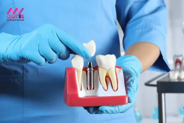 Trồng răng giả mất bao lâu? - Phương pháp trồng răng Implant