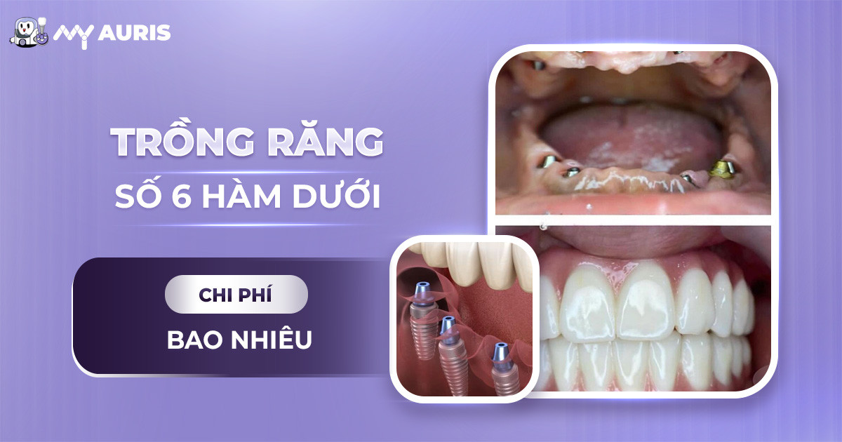 Trồng răng số 6 hàm dưới bao nhiêu tiền