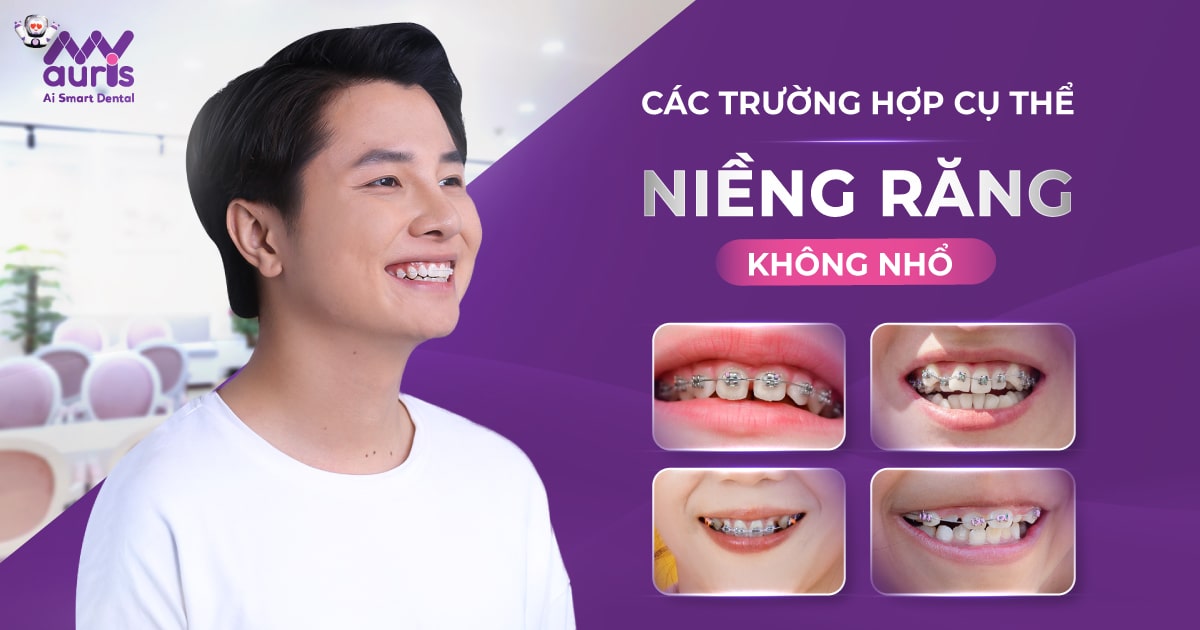 niềng răng ko nhổ