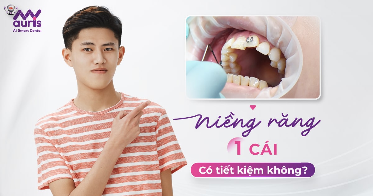 niềng răng 1 cái