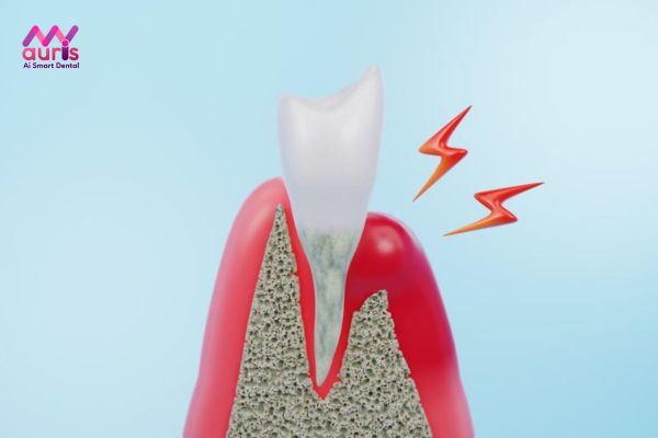 Viêm nướu răng có mủ là tình trạng biểu hiện như thế nào?
