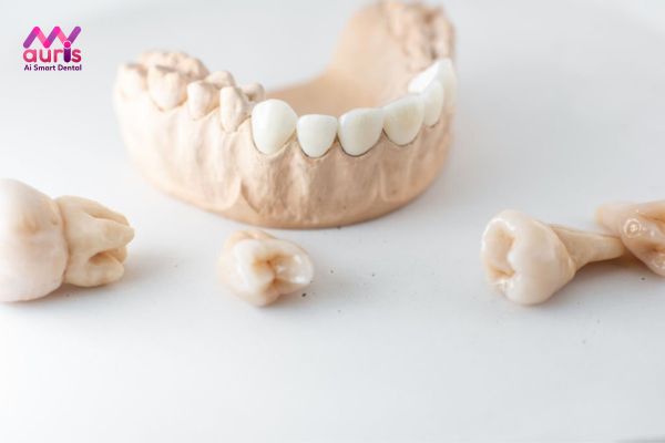 Tại sao chi phí làm răng sứ Titan rẻ hơn so với những loại răng khác?