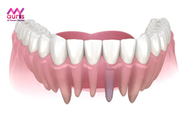 Ưu nhược điểm của phương pháp trồng răng Implant