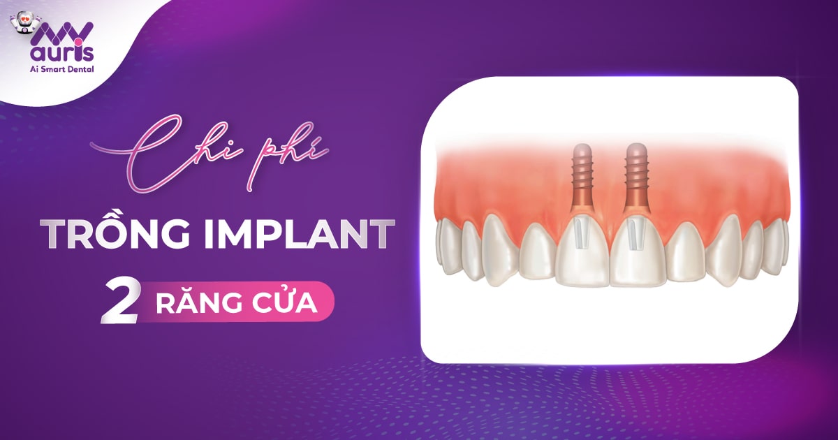 Tìm hiểu chi phí trồng Implant 2 răng cửa bao nhiêu?