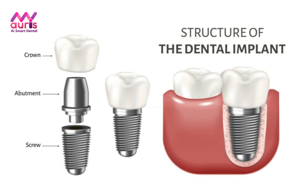 Công nghệ trồng răng Implant không đau là gì?