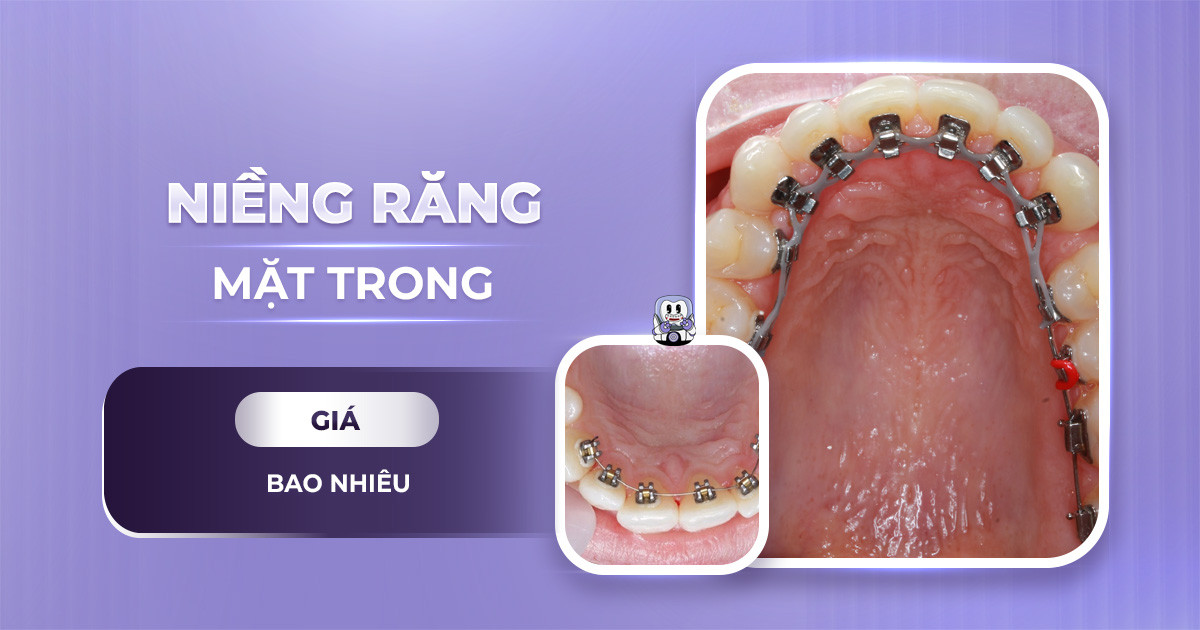 giá niềng răng mắc cài mặt trong