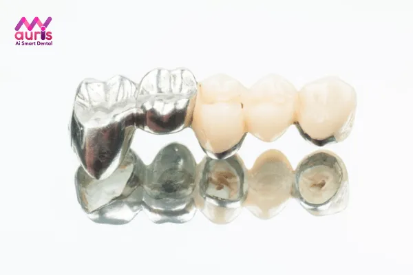 Giá trồng răng sứ cố định với cầu răng sứ