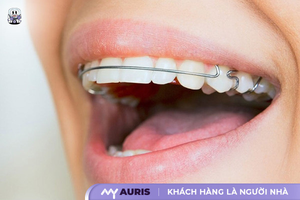 hàm duy trì sau niềng răng, các loại hàm duy trì