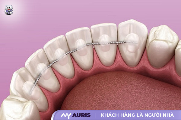 hàm duy trì sau niềng răng, các loại hàm duy trì