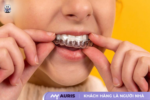 hàm duy trì sau niềng răng, các loại hàm duy trì