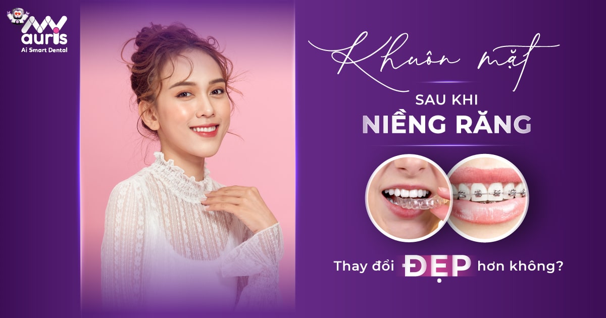 Khuôn mặt sau khi niềng răng thay đổi đẹp hơn không?