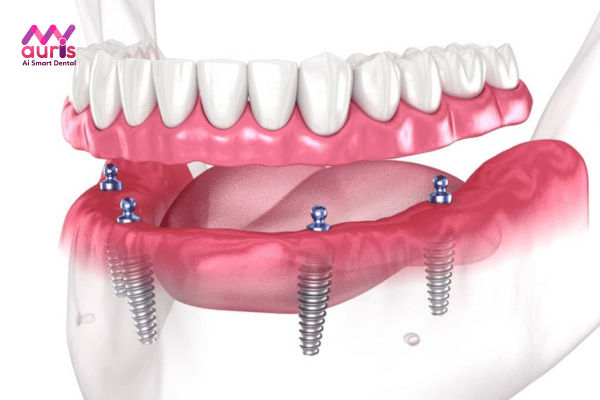 Thực hiện trồng răng toàn hàm - Giải pháp thay thế hoàn hảo cho hàm tháo lắp